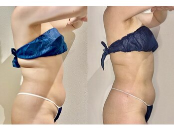 カルナ(CARNA)/【痩身】セルライトゼロ2