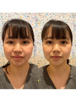 リッカ(Ricca)/３回施術の変化