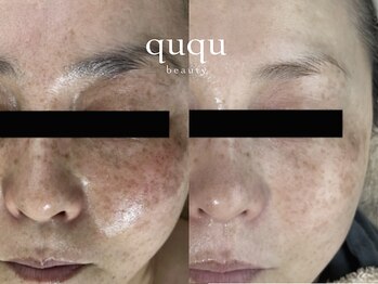 クク(ququ)/シミケア・くすみケア