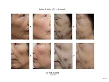 グリーンピール専門サロン &nbsp;SHANTI【シャンティ】/ピュールボーテ化粧品