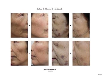 グリーンピール専門サロン SHANTI【シャンティ】/ピュールボーテ化粧品