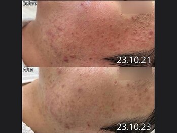 キュライム 熊本(CURAIM)/美肌管理【20代女性】