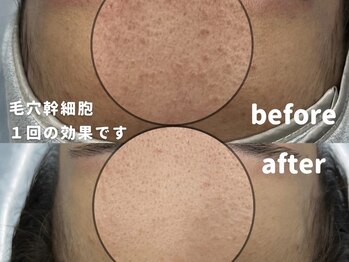 韓美 表参道店(HANMI)/毛穴洗浄×幹細胞導入[表参道]