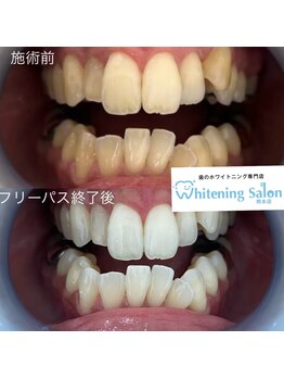 ホワイトニングサロン 熊本店/熊本ホワイトニング