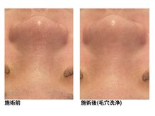 オーシャンブルー 佐世保店(OCEAN BLUE)/毛穴の黒ずみケア（毛穴洗浄）
