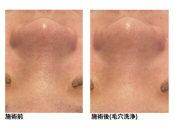 オーシャンブルー 佐世保店(OCEAN BLUE)/毛穴の黒ずみケア（毛穴洗浄）