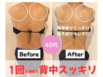 パリライム(parislime)/1回の施術で背中スッキリ!