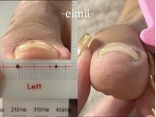 エイミー(eimii)/巻き爪ケア