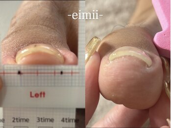 エイミー(eimii)/巻き爪ケア
