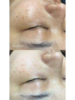 スマイルネイル(SMILE NAIL)/ハーブピーリング