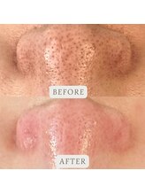 ミスティビオ 平尾店(mistyBIO)/《毛穴ケア》