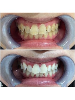 ルミナ(LUMINA)/プレミアムホワイトニング