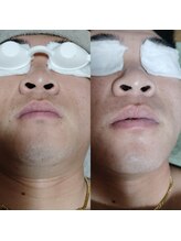 スリール(sourire)/ビフォーアフター