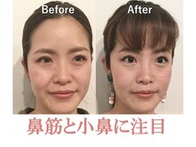 ラプリシュシュ 岡山店(Raplit)/隆鼻＋輪郭矯正40分10回