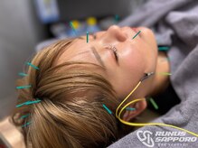 ラナスサッポロ(RUNUS SAPPORO)/【美容鍼】