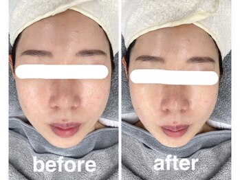 ハロ 南青山(HALO)/小顔スタンプフェイシャル¥8000