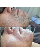 ミラージュ(mirage)/髭ワックス脱毛