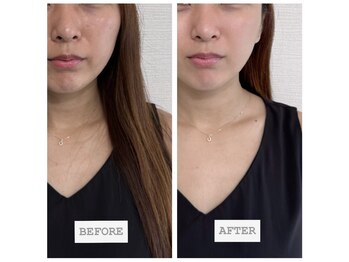 レジュヴィア(Re:JUvia)/肌質改善ビフォーアフター