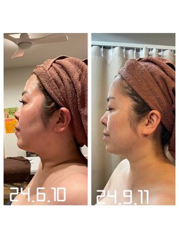 スピード美人 銀座店/顔セルで小顔&幼顔に!