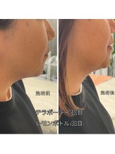 ベルフィーヌ ノーブル(BELLEFINE noble)/即効小顔レモンボトル