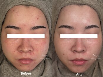 マウ(Mau)/集中プログラム