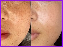 ヴィオール 名古屋栄店(VIOR)/シミ改善・色素改善　光ショット