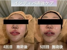 ラディアント(Radiant)/インディバ術後ケア/肌質改善