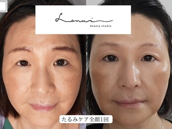 ラヌイ(LANUI)の写真/福岡初◎韓国で人気施術プラズマの力で効果実感♪博多/天神/中洲/春吉エリアで初導入