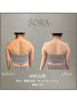 ソラ 天神 大名(SORA)の写真/冷やして流す脂肪冷却×キャビ｜落ちにくい背中・お腹・腰・太ももに。初回2cup￥3,980