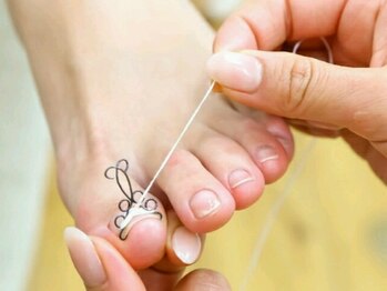 オーガニックネイルサロン プティ ボア(petit bois)の写真/【巻き爪でお悩みの方必見!!】Dr.監修!巻爪矯正で辛い痛みから解放♪ストレスなく歩けるように導きます☆