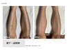 【メンズ脱毛】"最新THR方式美肌脱毛"選べる3ヶ所¥13200