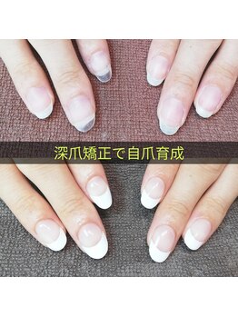 マニエネイル(mani e nail)/深爪矯正で自爪育成の途中経過