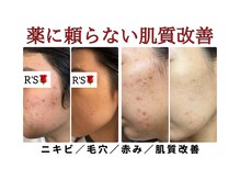 BEAUTY SALON R’s　南風原　【ハーブピーリング・痩身】