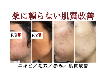 BEAUTY SALON R’s　南風原　【ハーブピーリング・痩身】