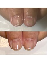 剥離爪のお悩み解地爪育成ケア