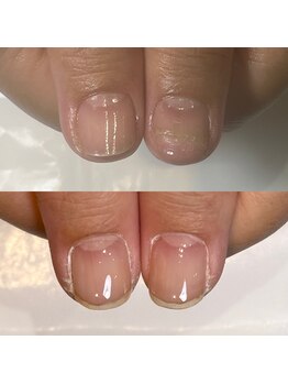 キュア(Cure.)/剥離爪のお悩み解地爪育成ケア