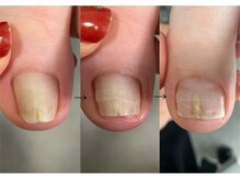 ロンディネ(Rondine)/巻き爪ケア&ネイルトリム0903