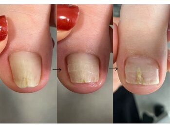 ロンディネ(Rondine)/巻き爪ケア&ネイルトリム0903