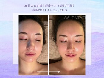 サロン タエン/施術後ケア｜フェイスライン