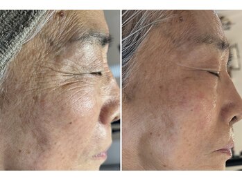 美時雨の写真/年齢肌諦めていませんか?徹底肌管理でシワ・シミ改善!予防ケアで目指す、ハリのある若見え肌♪