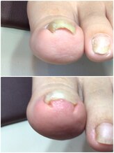 モアクリスタル(More Crystal)/巻き爪補正