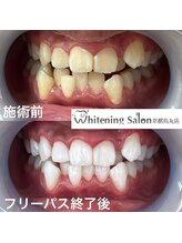 ホワイトニングサロン 京都烏丸店/ホワイトニング施術例