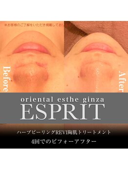 エスプリ 銀座店/ハーブピーリング銀座