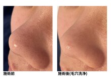 オーシャンブルー 佐世保店(OCEAN BLUE)/毛穴の黒ずみケア（毛穴洗浄）