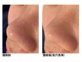 オーシャンブルー 佐世保店(OCEAN BLUE)/毛穴の黒ずみケア（毛穴洗浄）