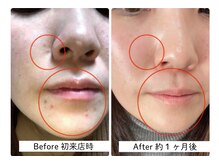 サルヴァトーレ 長崎/シミシワ改善/ニキビケア/毛穴