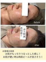 フワリ(FUWARI)/陶肌トリートメント・陶肌ピール