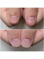 エムユーファイブネイル(MU5-nail)&nbsp;深爪は勿論！甘皮のささくれなども綺麗になっていきます★