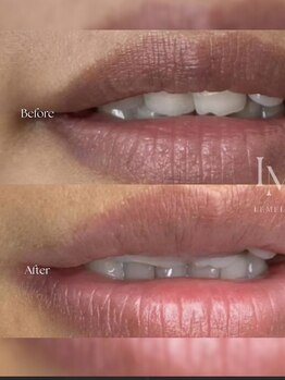 クローバー 松戸(clover)/【ルメラ】リップ　黒ずみケア