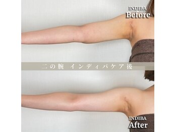 術後の女神 大阪本町店/ダウンタイムケア・インディバ